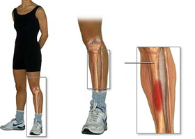 Bóle piszczeli u biegaczy - jak sobie z nimi radzić?